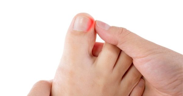 Ingrown toenail causes, treatments, and prevention