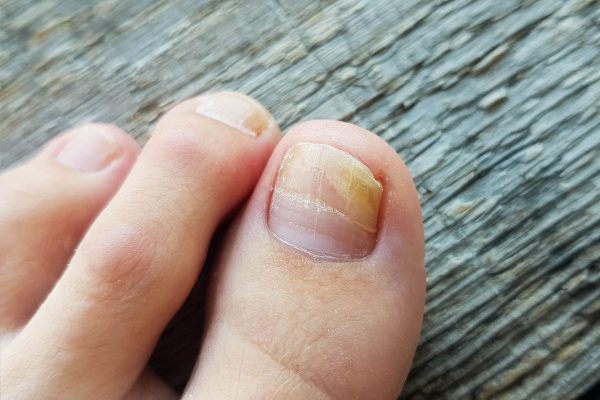 Nail Fungus: The Hidden Invader and How to Defeat It